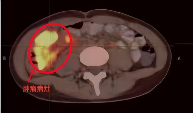 14岁女孩肠癌晚期腹痛半年以为痛经 早筛早治至关重要